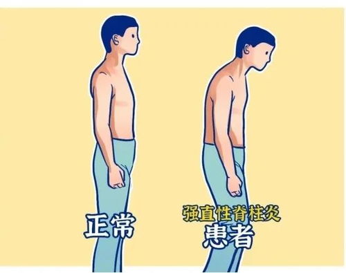 周杰伦强直性脊柱炎疑似加重(周杰伦疑似强直性脊柱炎病情加重，音乐巨星的健康挑战)