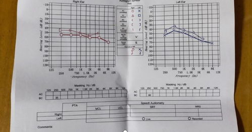 小伙戴耳机睡觉确诊神经性耳聋